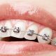 Ortodontik Tedavi Sırasında Dikkat Edilmesi Gerekenler