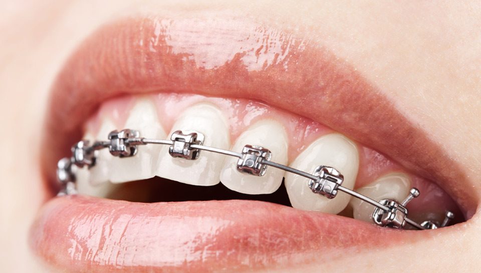 Ortodontik Tedavi Sırasında Dikkat Edilmesi Gerekenler