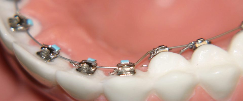 Bursa Ortodonti Uzmanları